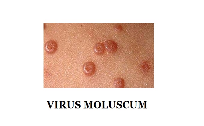 Virus Molluscum Contagiosum