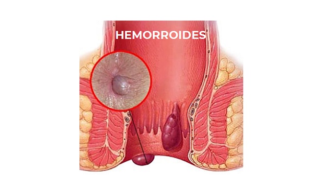 Hemorroides y sus remedios naturales